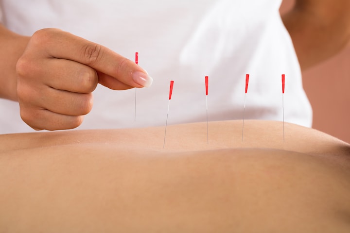 Akupunktur hos Akuveda Kliniken