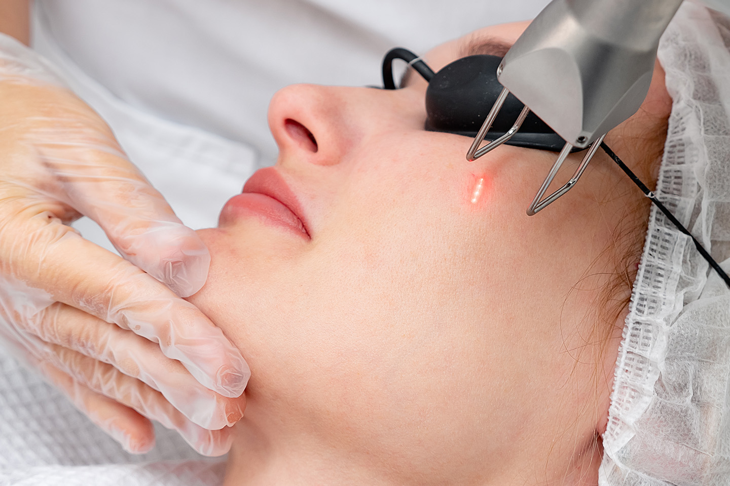 Laserbehandling för rynkor & skadad hud på Kungsholmen eller i Fittja