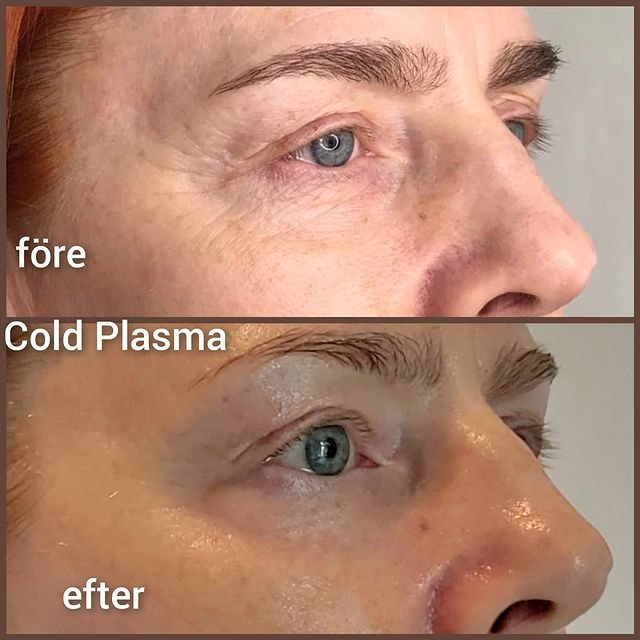 Cold plasma - för hela ansiktet (1 av 4)