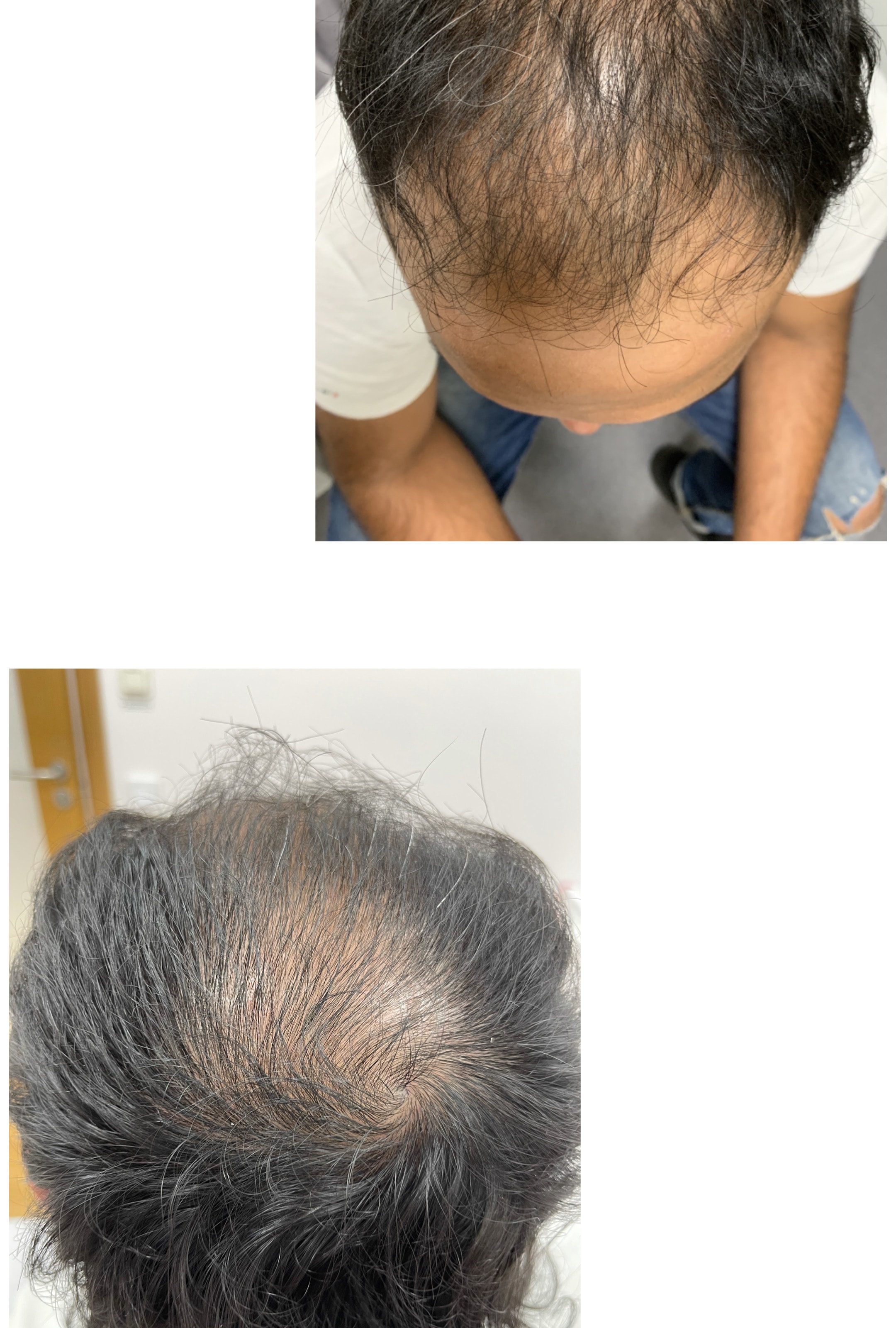 PRP-behandling för hår, ansikte eller dekolletage (1 av 2)
