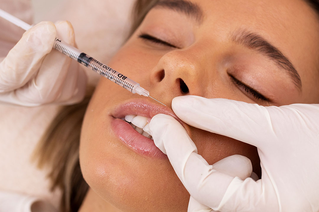 Lip flip med botulinumtoxin hos ASTA i Hammarby Sjöstad