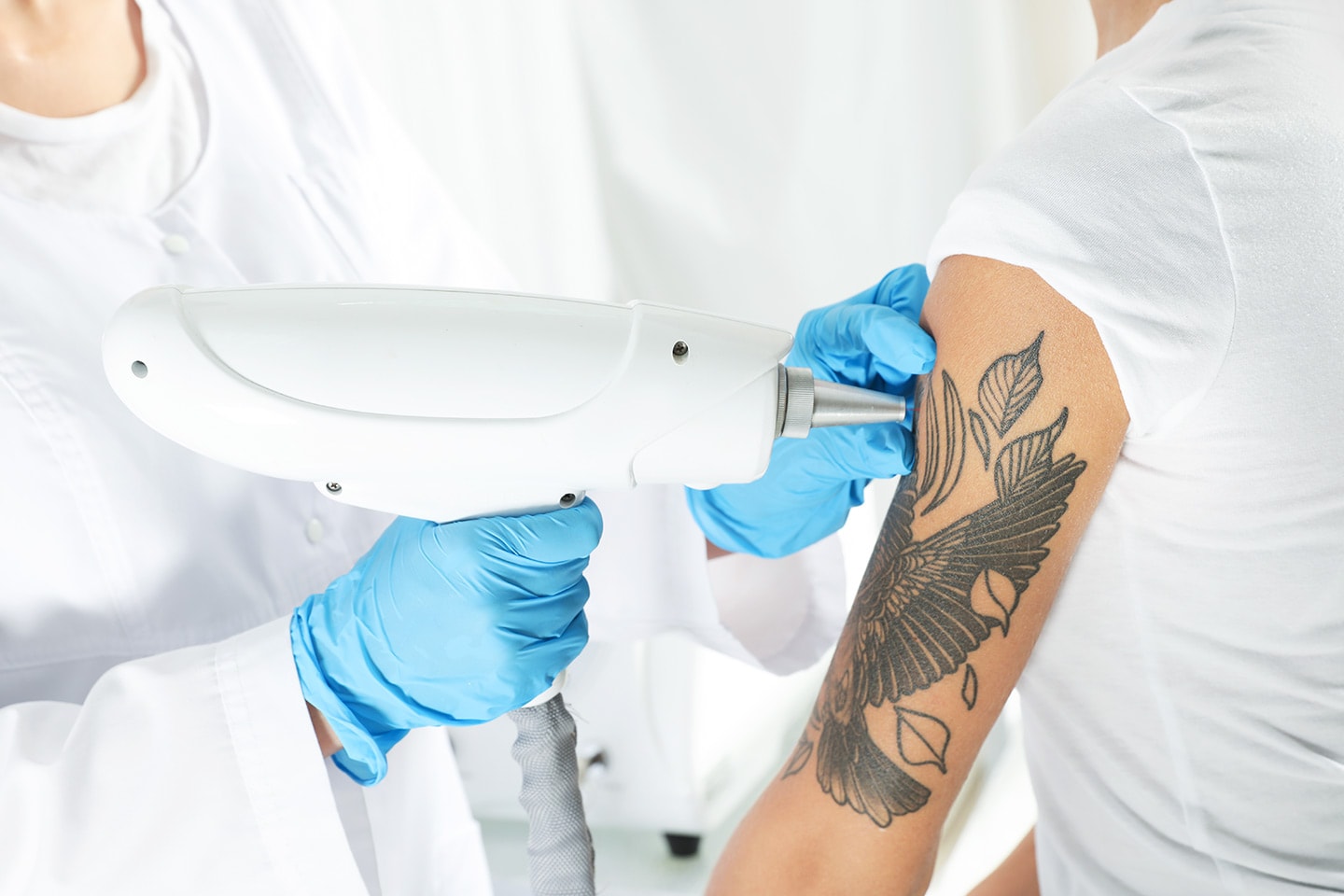 Tatueringsborttagning med laser (1 av 3)