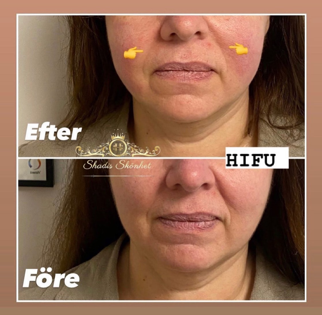 Ansiktslyft / hudåtstramning och fettreducering med HIFU 7D (2 av 14)