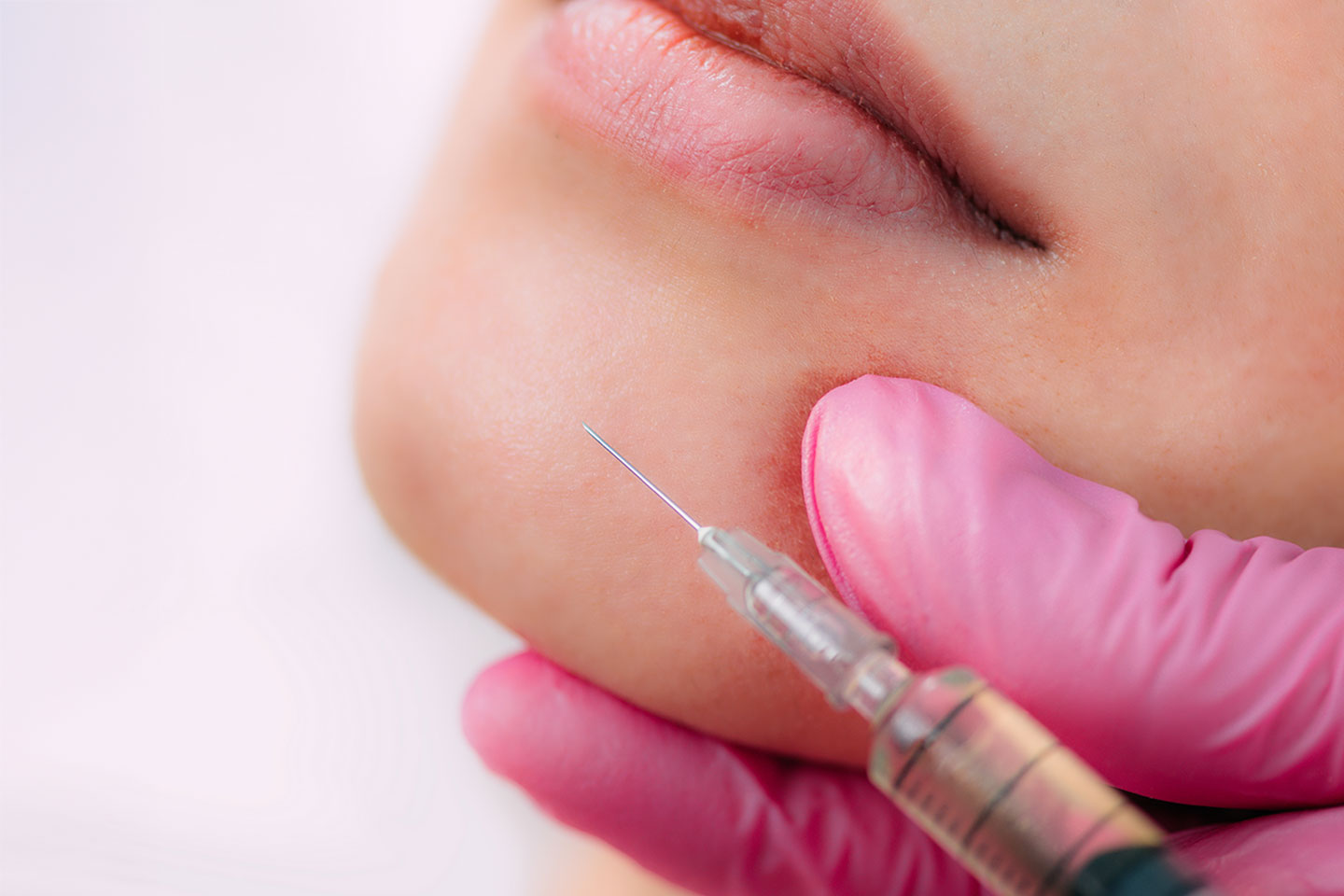 Fillers Stylage 1 ml på valfritt område hos Dr. Beauty vid Värnhemstorget