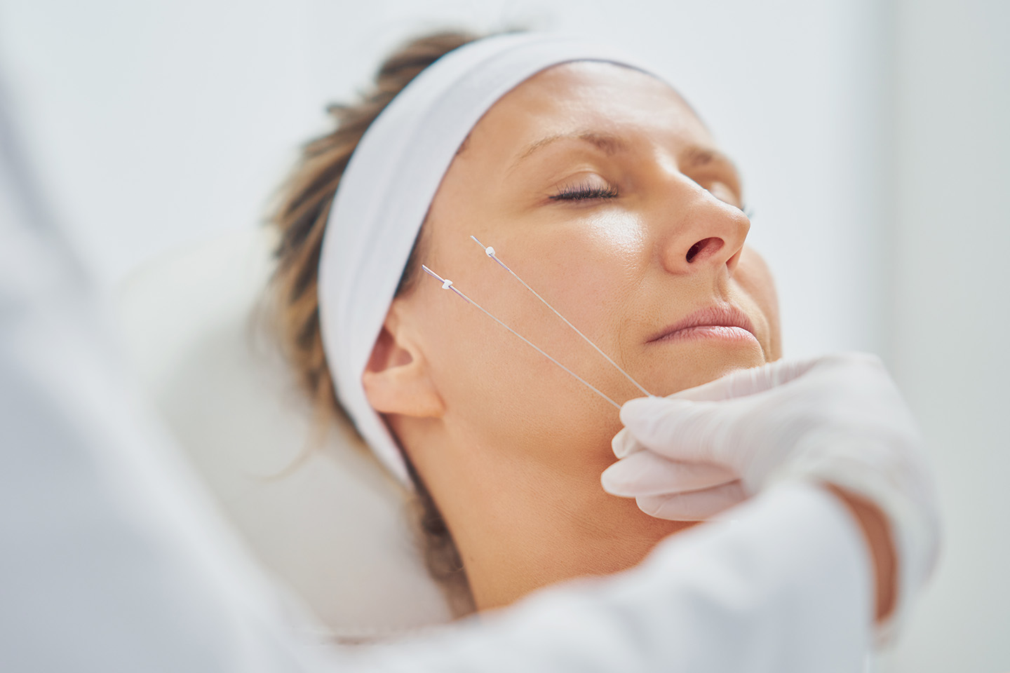 Trådlyft med Cogtrådar hos SkinMall vid Brunnsparken