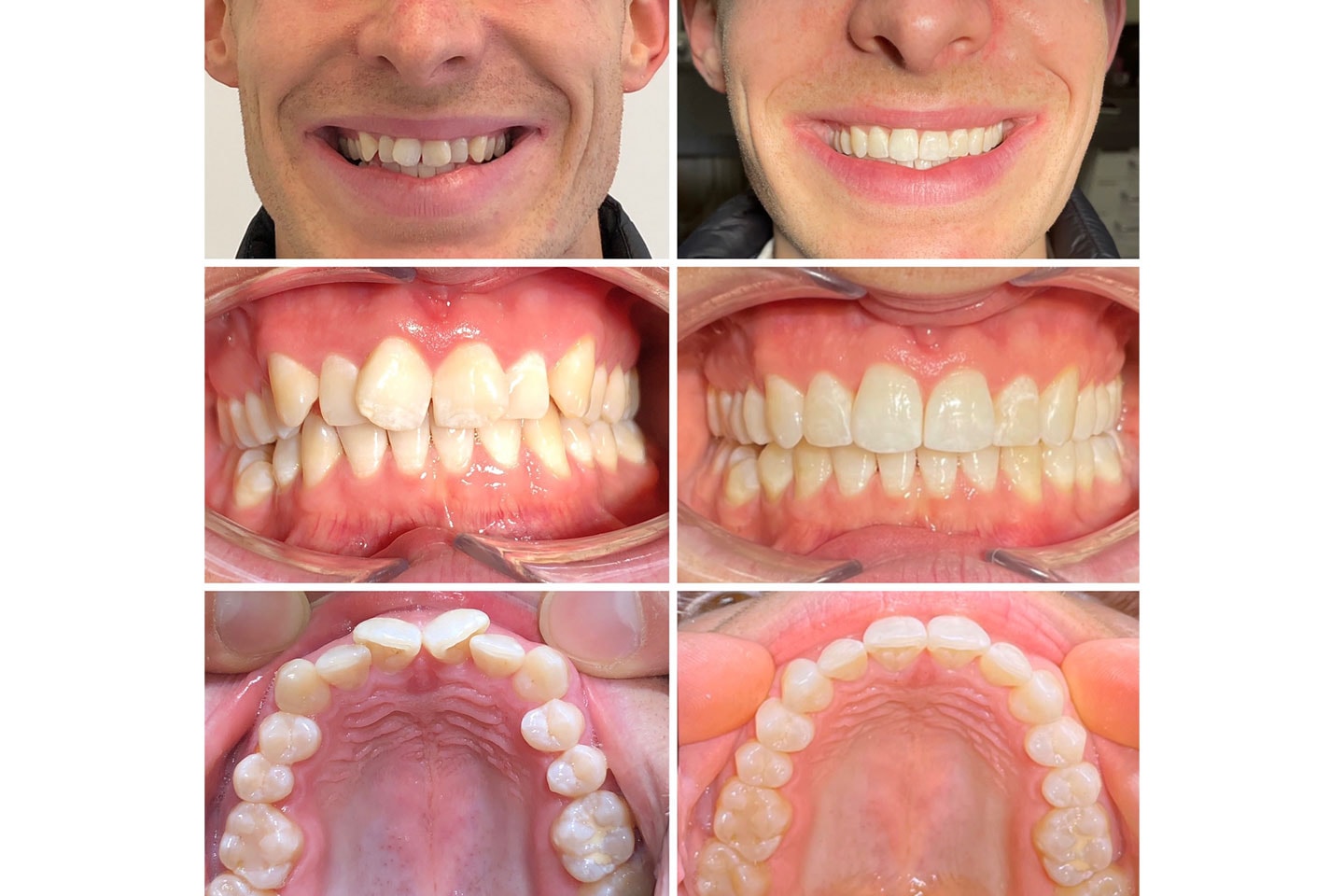 Tandreglering med Invisalign hos leg.tandläkare, nära Järntorget (9 av 12)