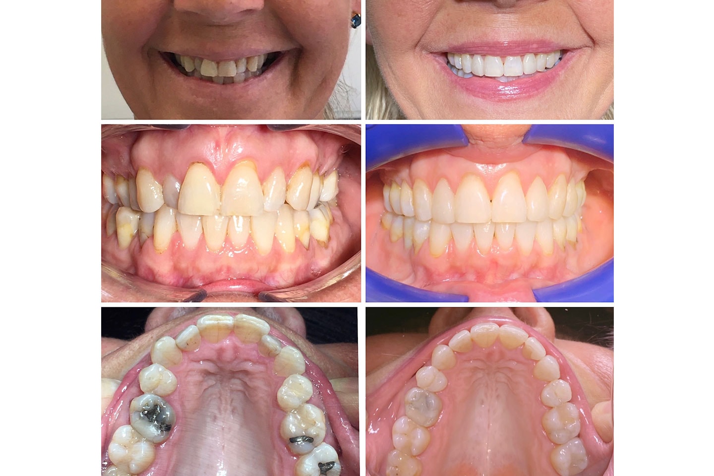 Tandreglering med Invisalign hos leg.tandläkare, nära Järntorget (8 av 12)