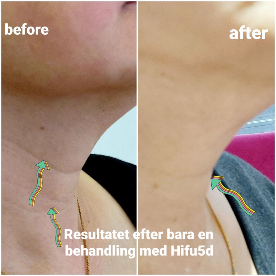 HIFU 3D/4D/5D för ansiktslyft/huduppstramning och fettreducering (3 av 5)