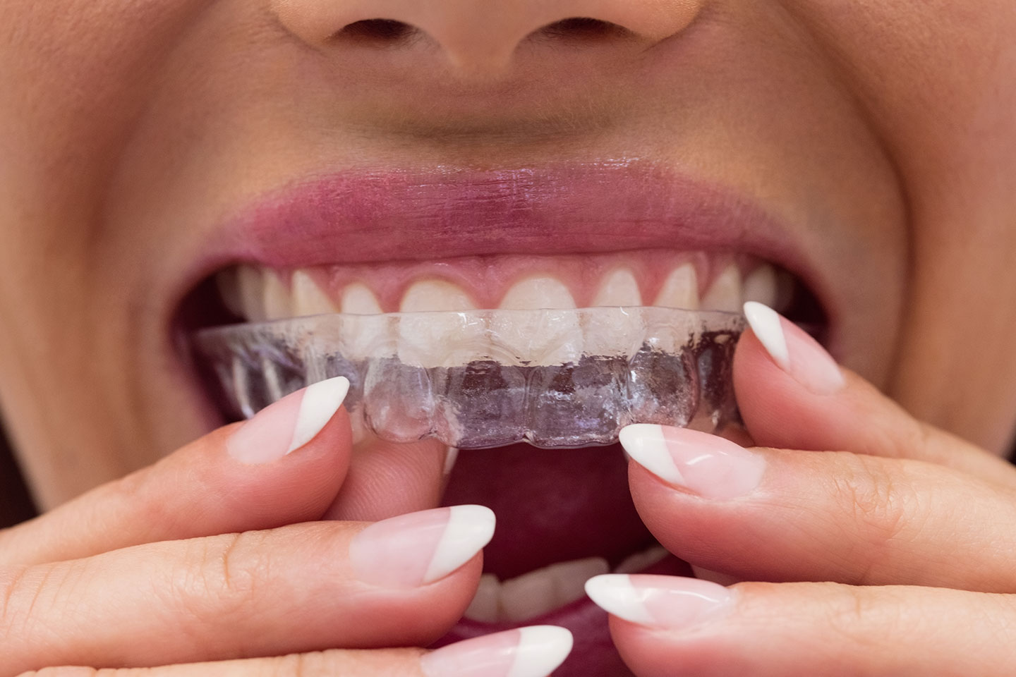 Bettskena mot tandgnissling & tandundersökning vid Gustav Adolfs torg