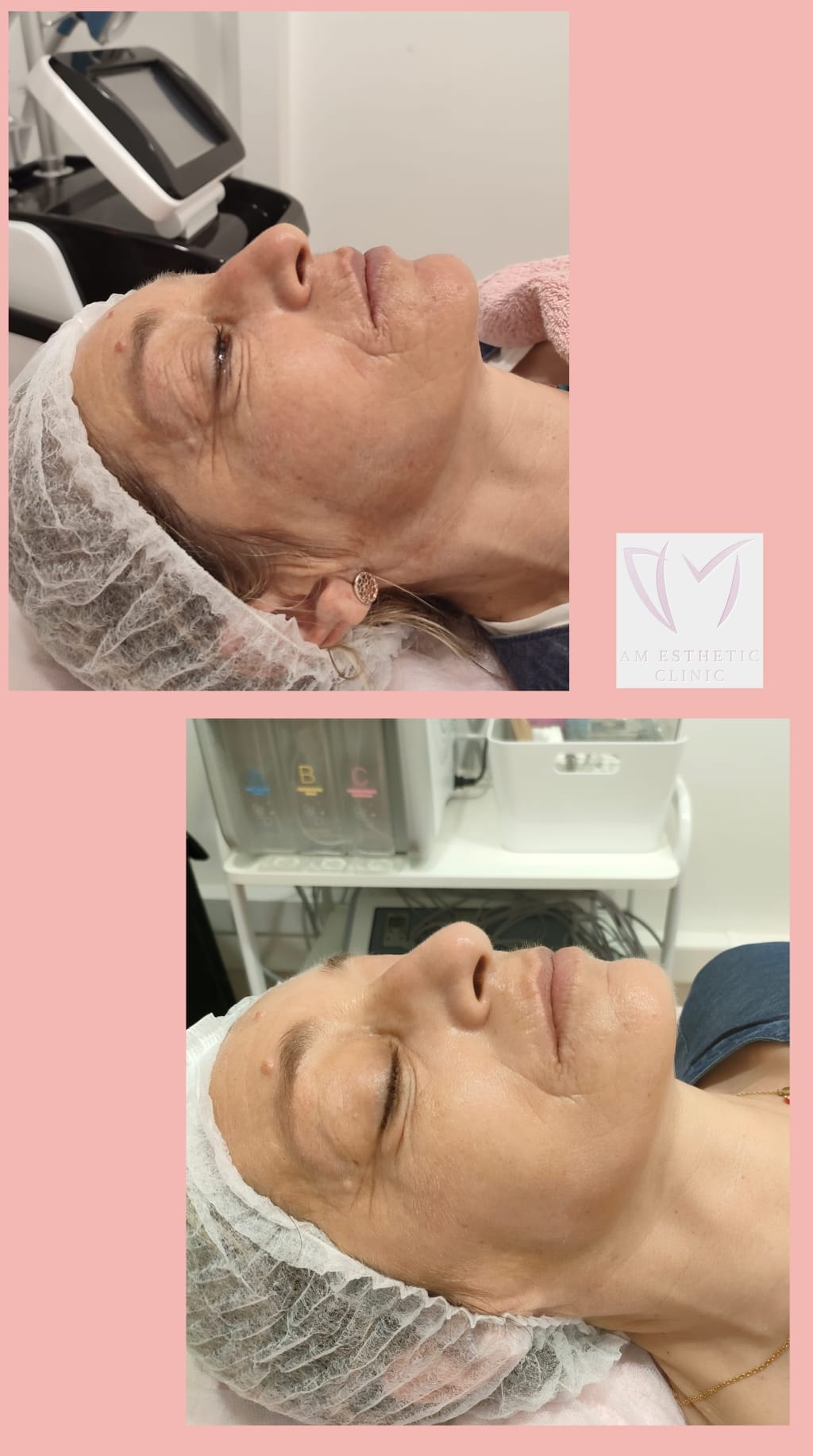Prøv den nye og effektive anti-age ansiktsbehandlingen VelaShape III (3 av 14)