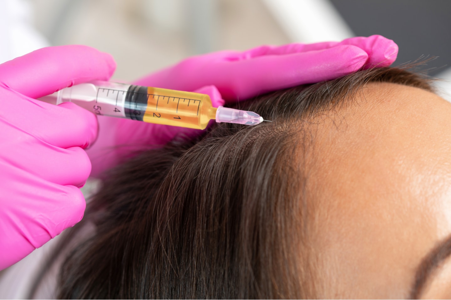 Behandla håravfall och tunnhårighet med RPR-behandling (1 av 4)