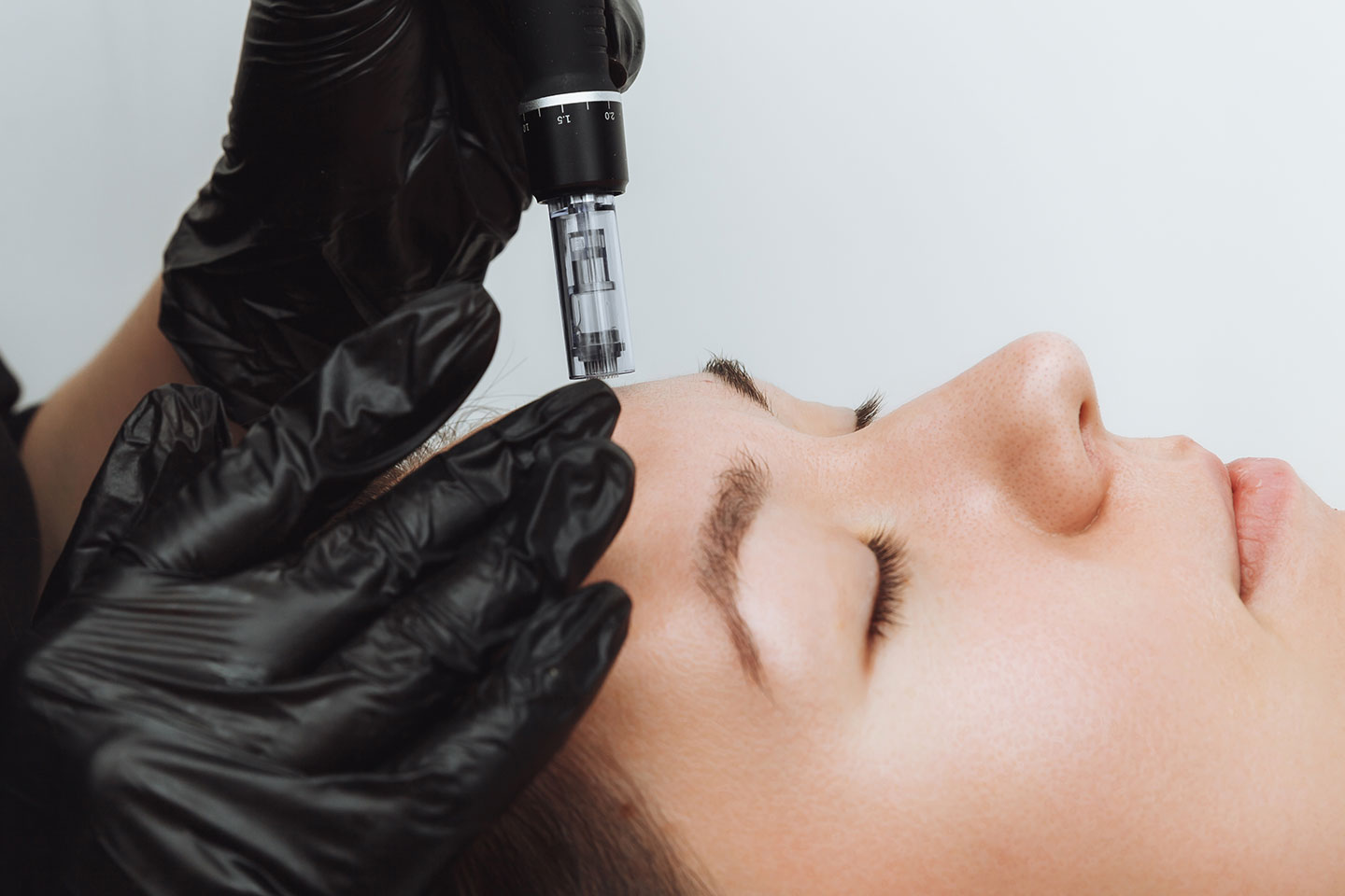 PRX-T33 med/utan Microneedling ansiktsbehandling på Kungsholmen