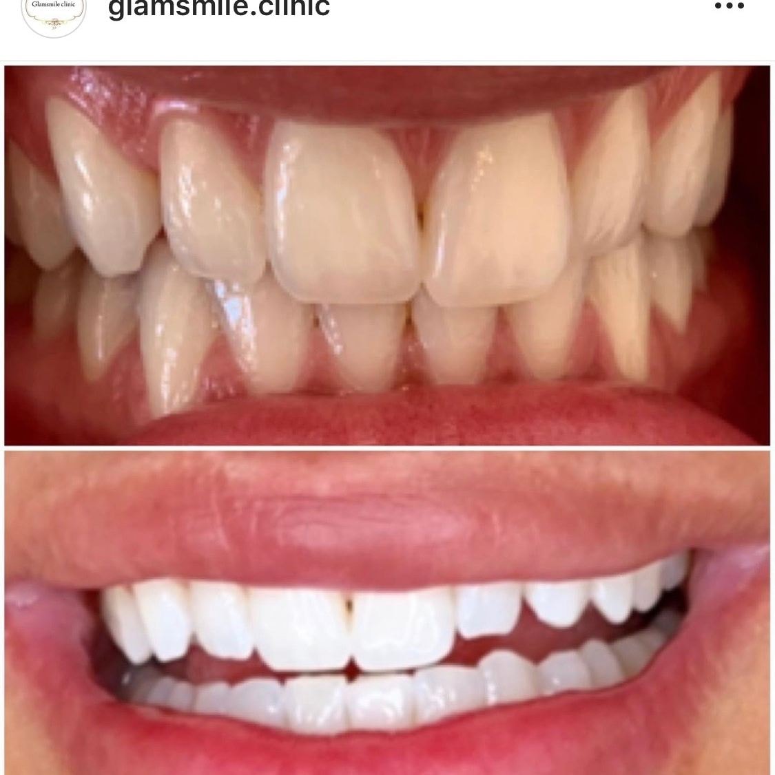 Glam Smiles tandblekning för hemmabruk (2 av 4)