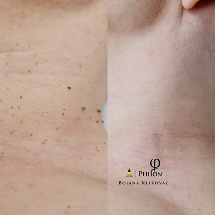 Plasma Pen - Behandla lös hud & hudförändringar hos Beauty Phix Center (1 av 5)