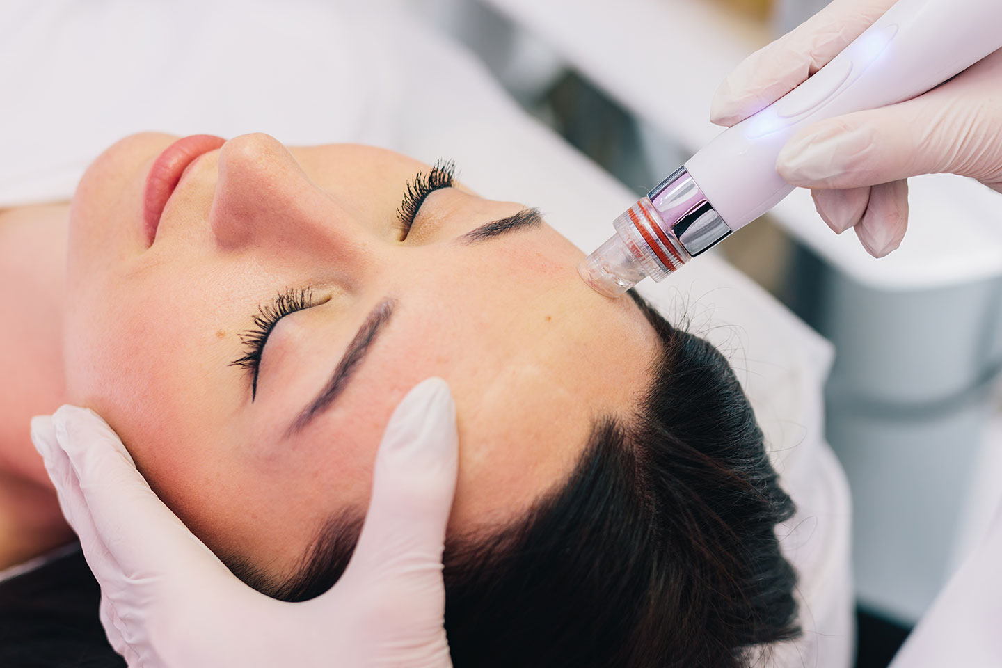 Microneedling med stamceller för hudföryngring vid Triangeln