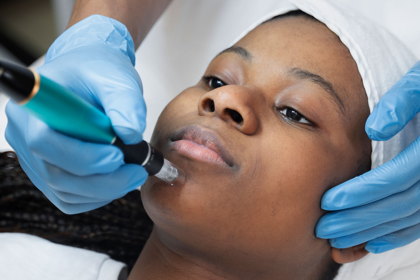 Microneedling & Salmon DNA (PDRN) ansiktsbehandling vid Triangeln