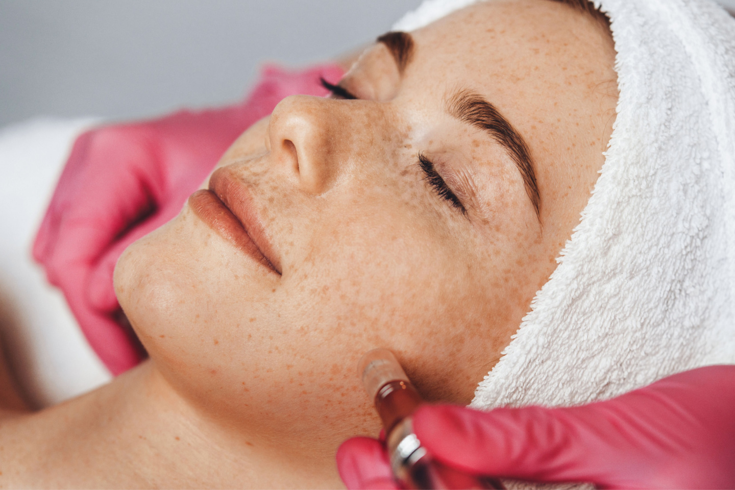 Microneedling med Dermapen och serum för hudföryngring på Södermalm