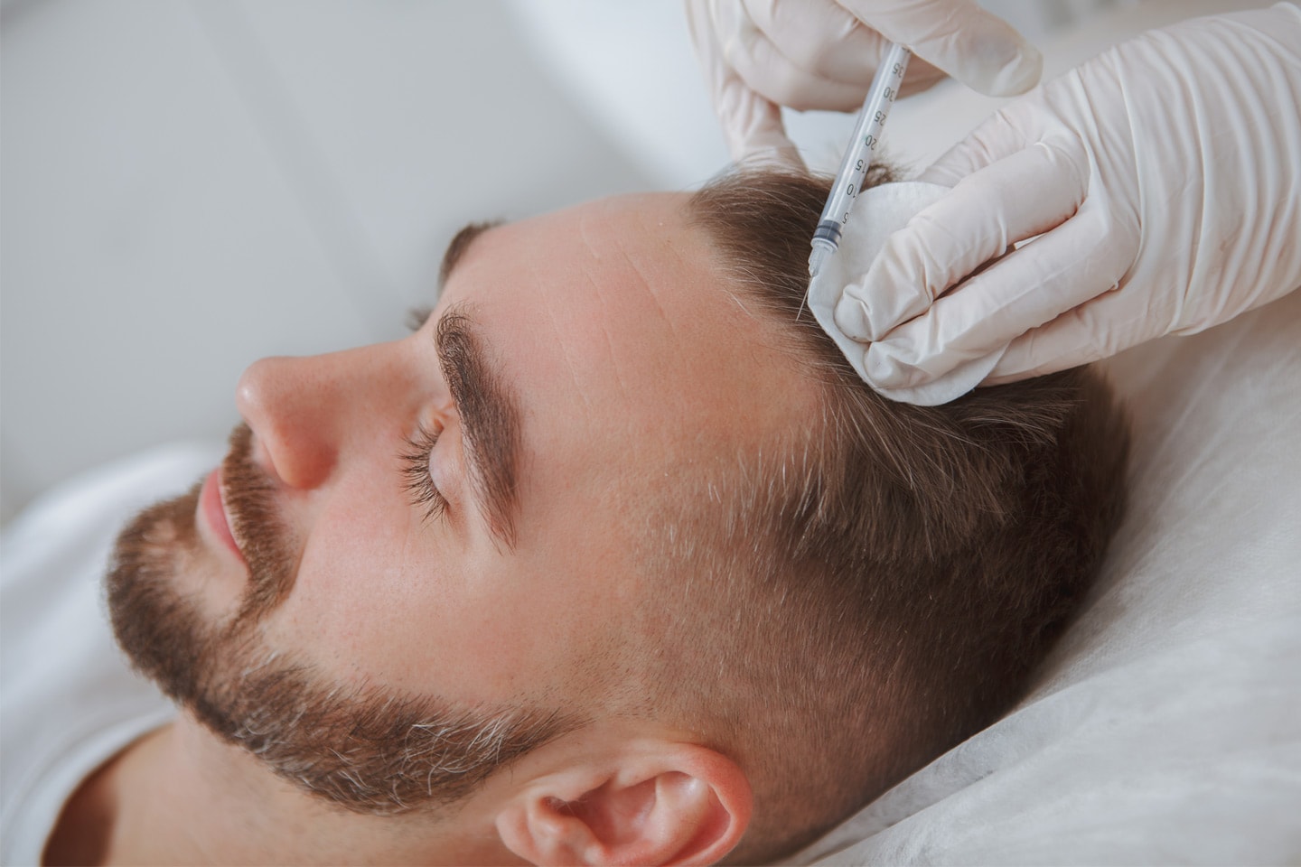 PRP-behandling mot håravfall eller för naturligt glow i ansiktet (1 av 4)