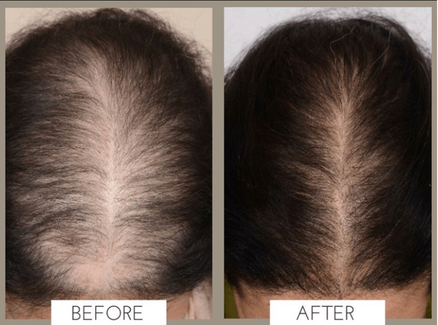 PRP-behandling för hår eller ansikte hos Viktoriya's Beauty Studio (1 av 3) (2 av 3)