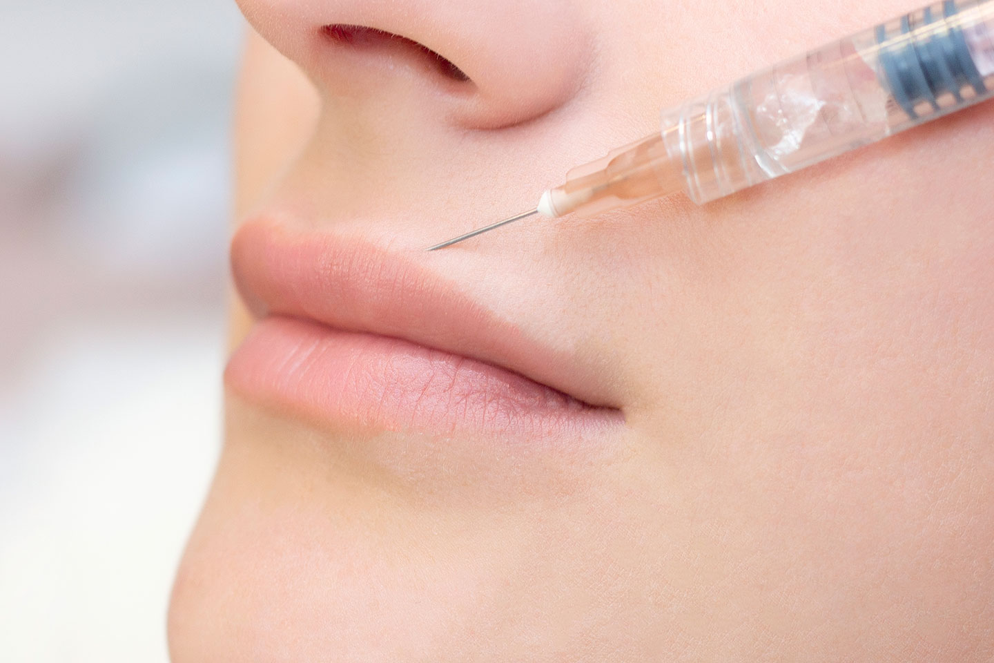 Fillers läppar 1 ml hos Mojgan Medical Clinic i Kista