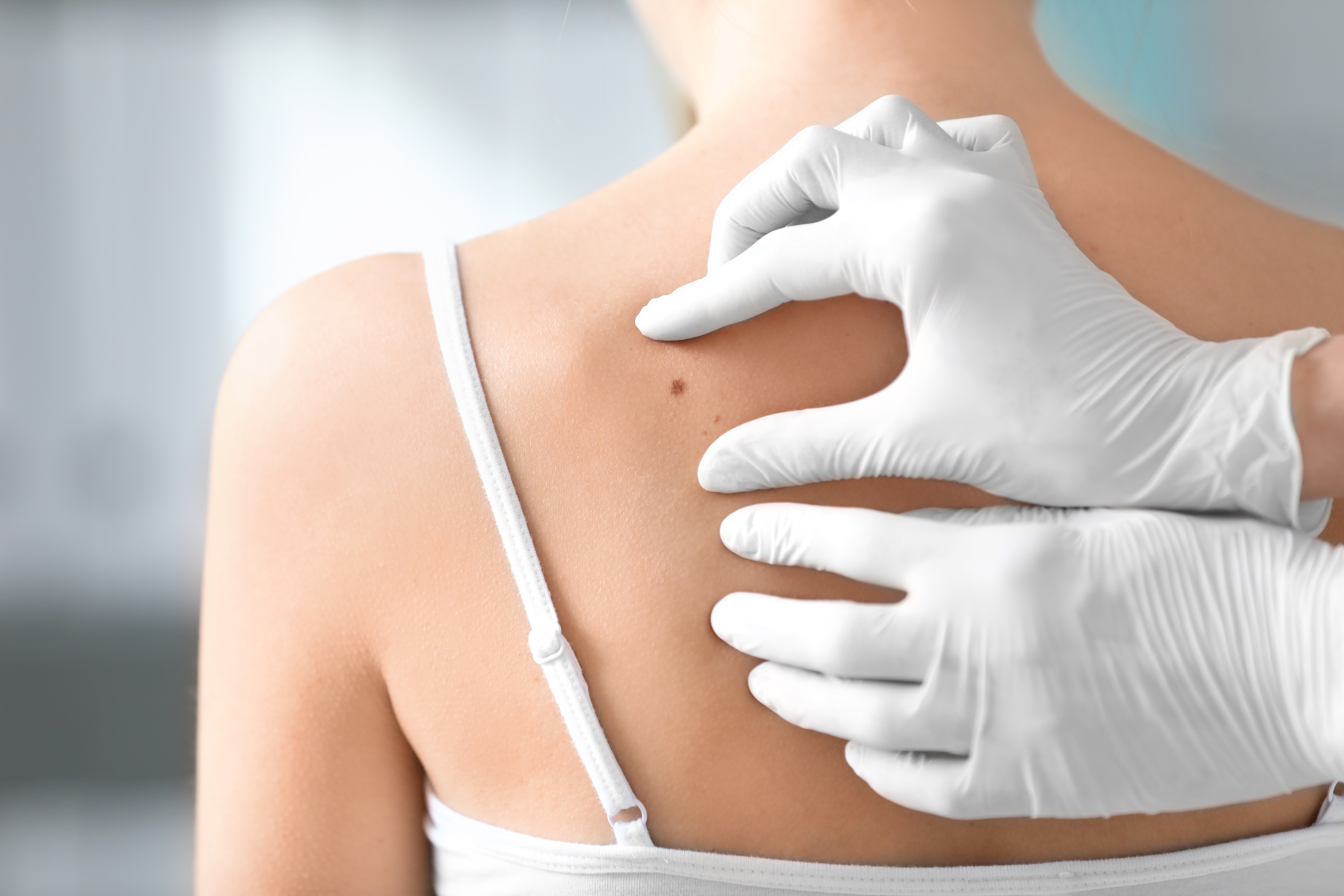 Fjerning av føflekk uansett størrelse hos Kalbakkenklinikken Medisinske