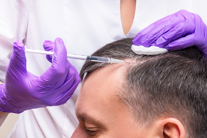 PRP-behandling mot håravfall vid Chalmersgatan