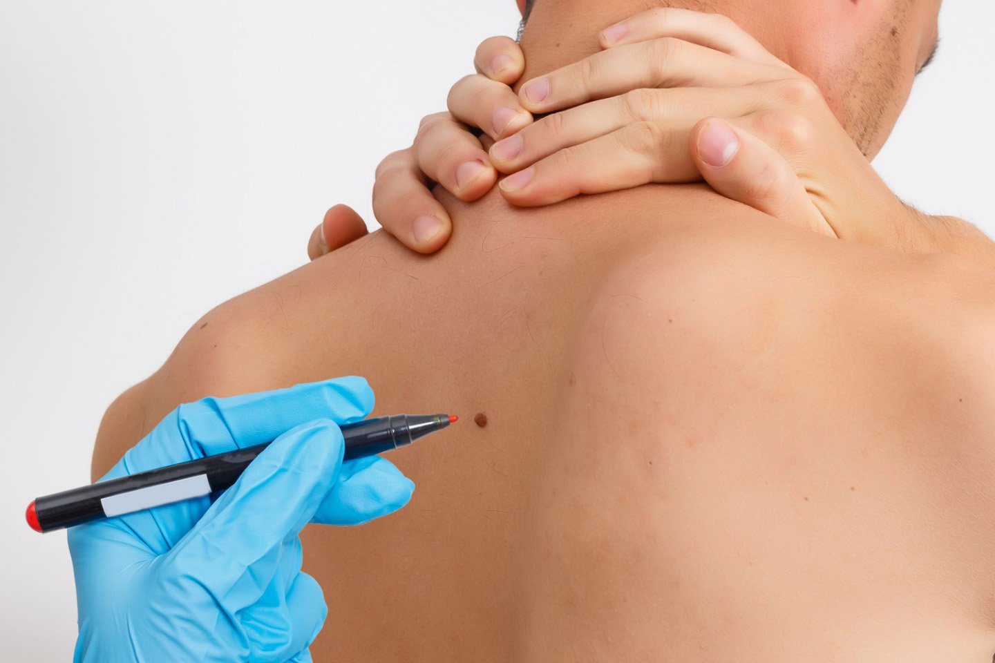 Ta bort leverfläckar och födelsemärken upp till 25 st hos Svenska Laser