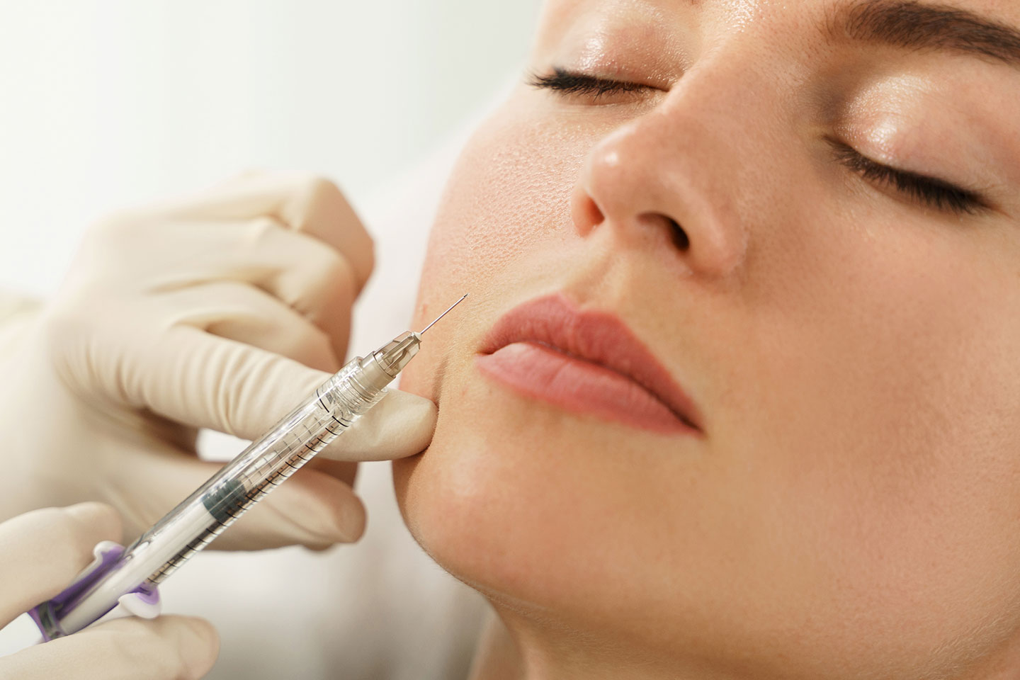 Fillers 1,5 ml med Stylage eller Revolax hos Dr. Beauty