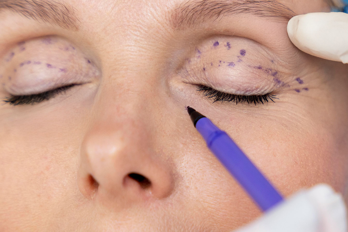 Ögonlocksplastik hos F.Imanuell Estetisk klinik på Östermalm