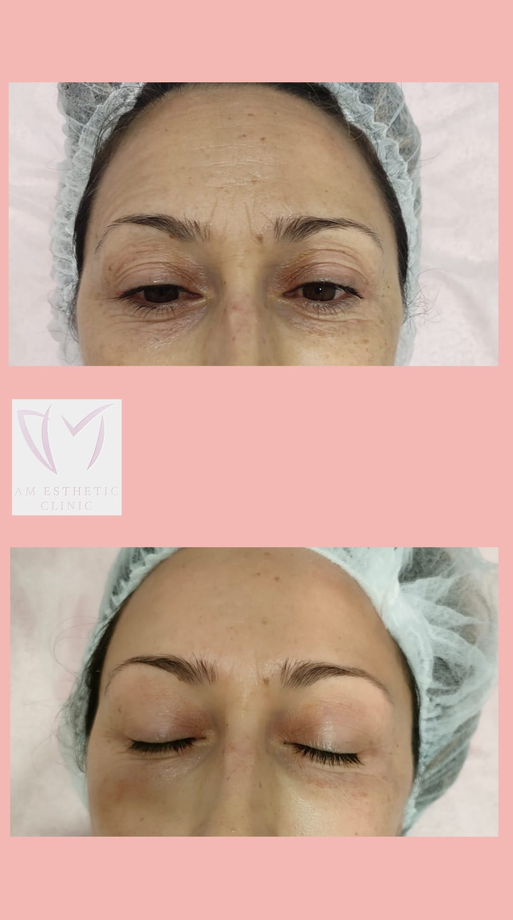 Prøv den nye og effektive anti-age ansiktsbehandlingen VelaShape III (1 av 14)