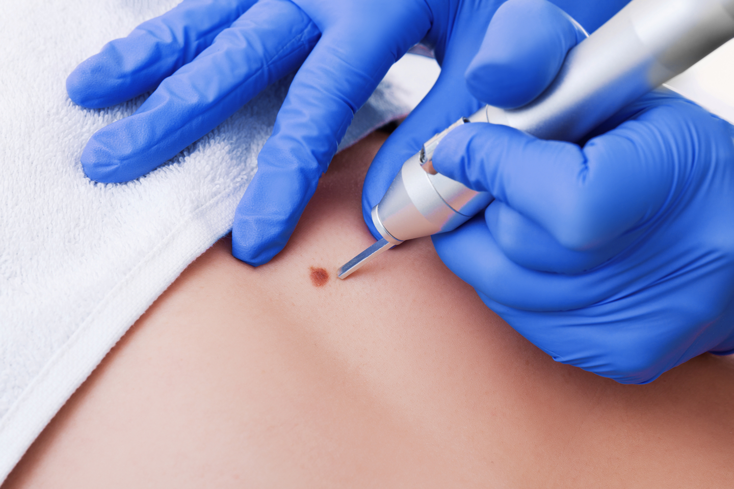 Borttagning av åldersfläckar, vårtor eller pigmentfläckar med Cryopen