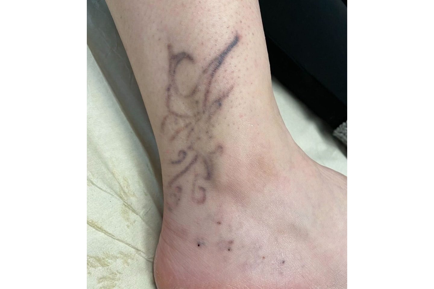 Ta bort tatuering med YAG-laser hos Göteborgs Estetisk Medicin Klinik (5 av 8)