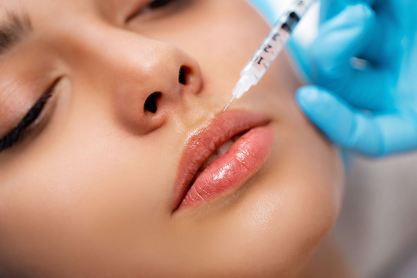 Fillers 1-2 ml på valfria områden hos Luxe Clinic 44 nära Ullevi