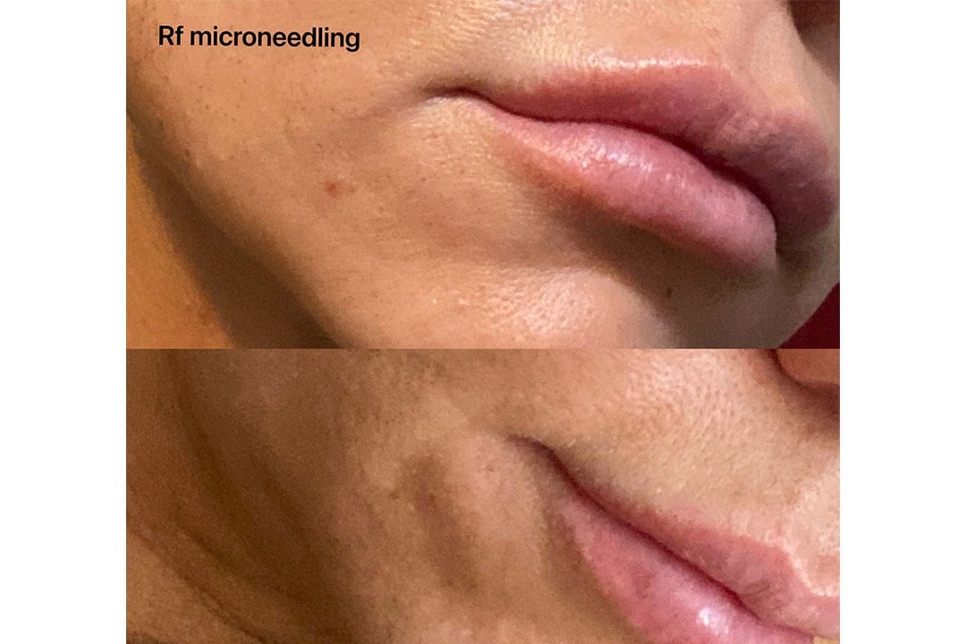 RF Microneedling för ansiktet (4 av 5) (5 av 5)