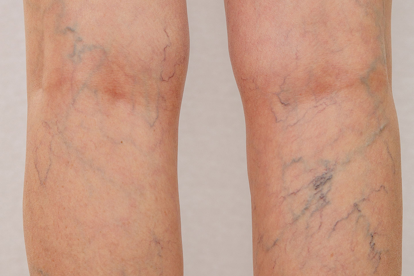 Ta bort ytliga blodkärl med laser hos Lemoge Clinic på Norrmalm