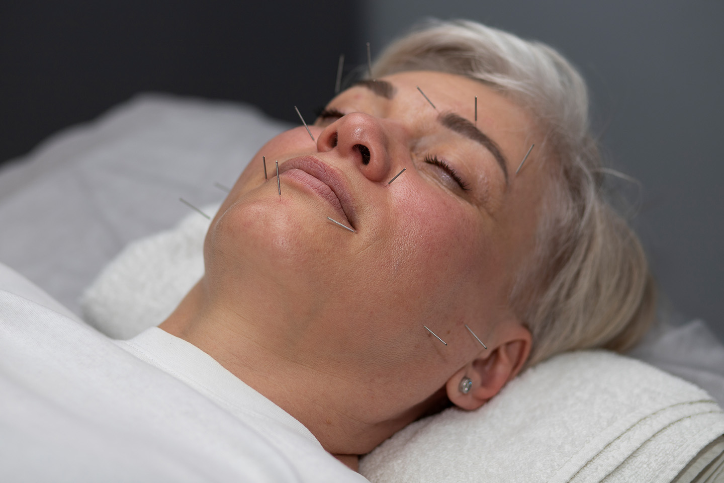 Akupunktur för smärtlindring och spänningar 55 minuter i Kvillebäcken