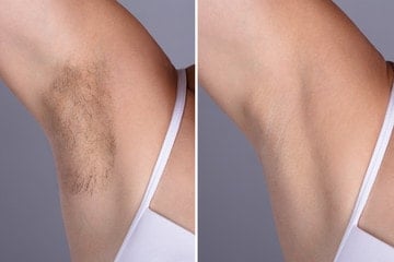 Permanent hårborttagning med laser hos Alfa Skönhetsklinik (2 av 6)