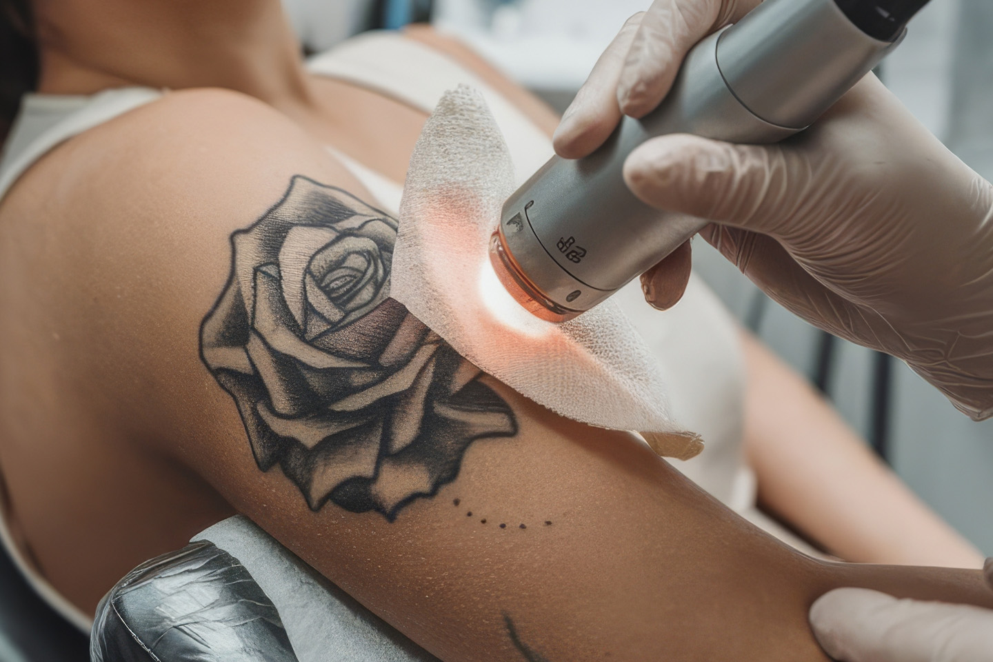 Tatueringsborttagning med laser hos Sara Beauty Center i Linné