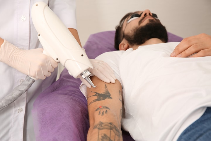 Tatueringsborttagning med Yag- laser hos Kungliga skönhetskliniken
