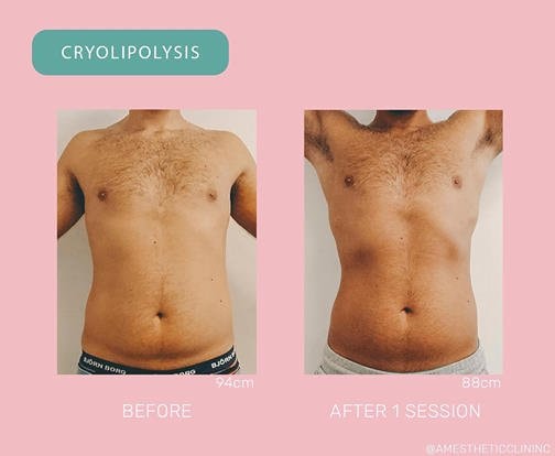 Fjern uønsket fett med Cryolipolysis fettfrysing hos anerkjente AM Esthetic Clinic (8 av 9)