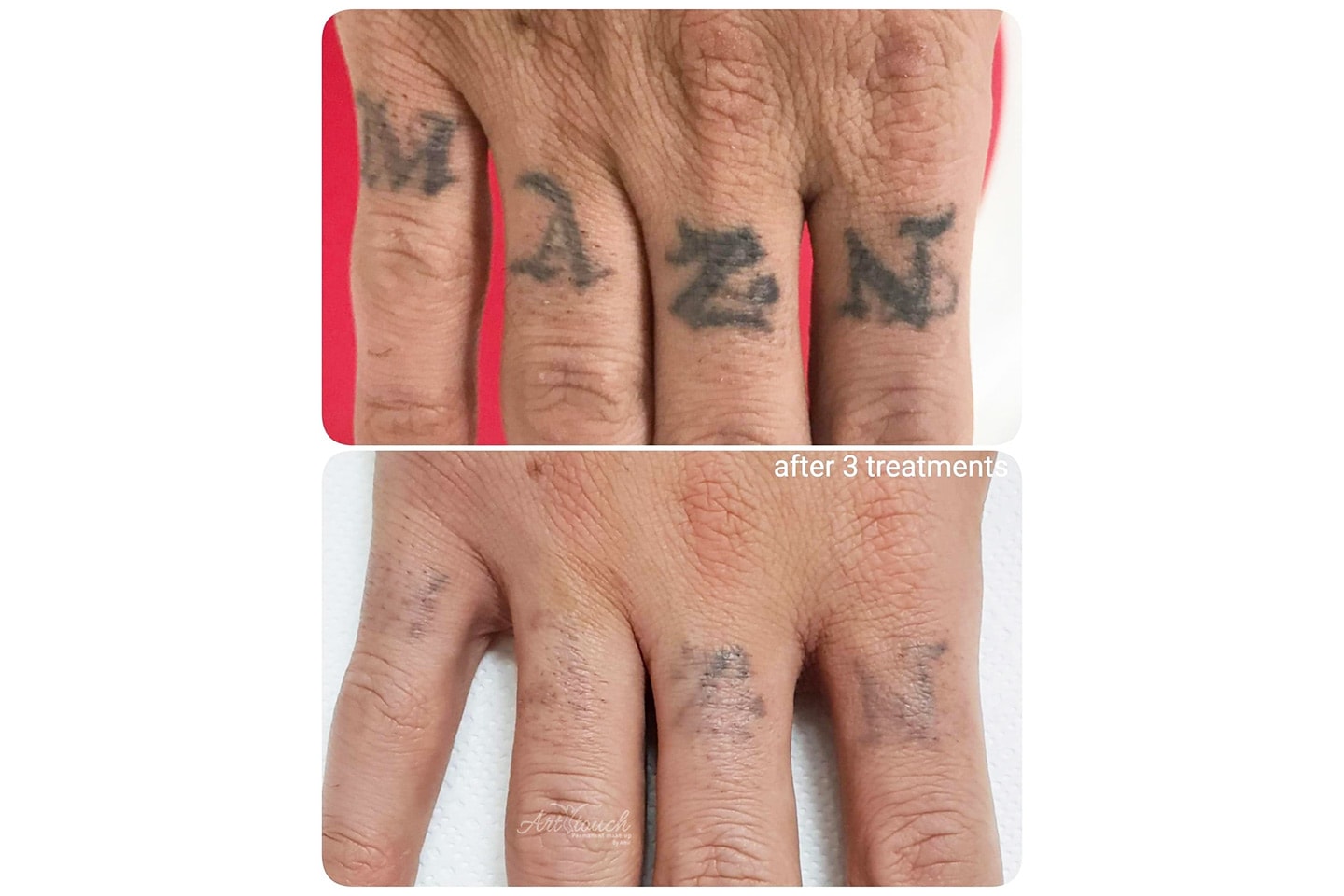 Tatueringsborttagning med laser, upp till 3 behandlingar (3 av 5)