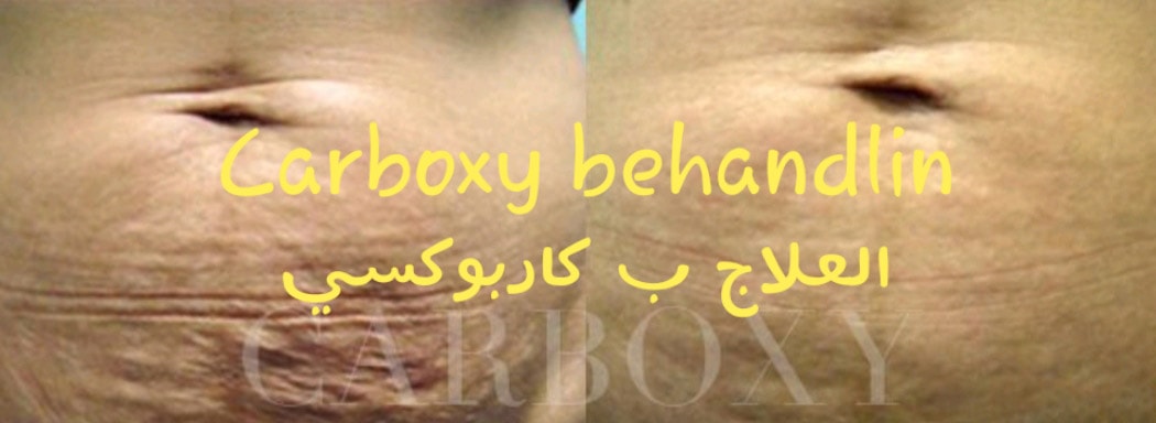 Ge huden ny lyster med en carboxy-behandling (1 av 2)
