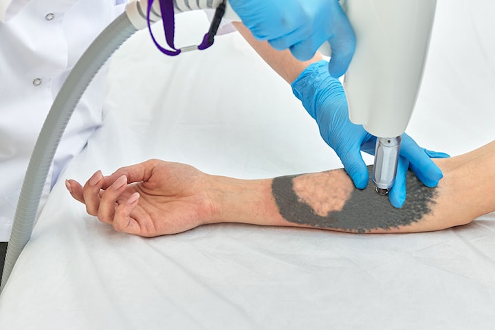 Ta bort tatuering med YAG-laser hos Göteborgs Estetisk Medicin Klinik