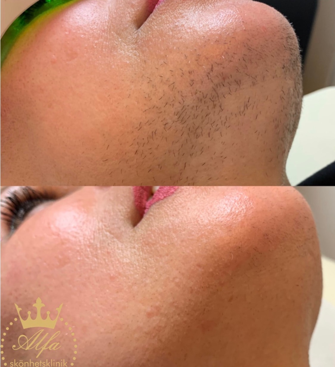 Permanent hårborttagning med laser hos Alfa Skönhetsklinik (3 av 6)
