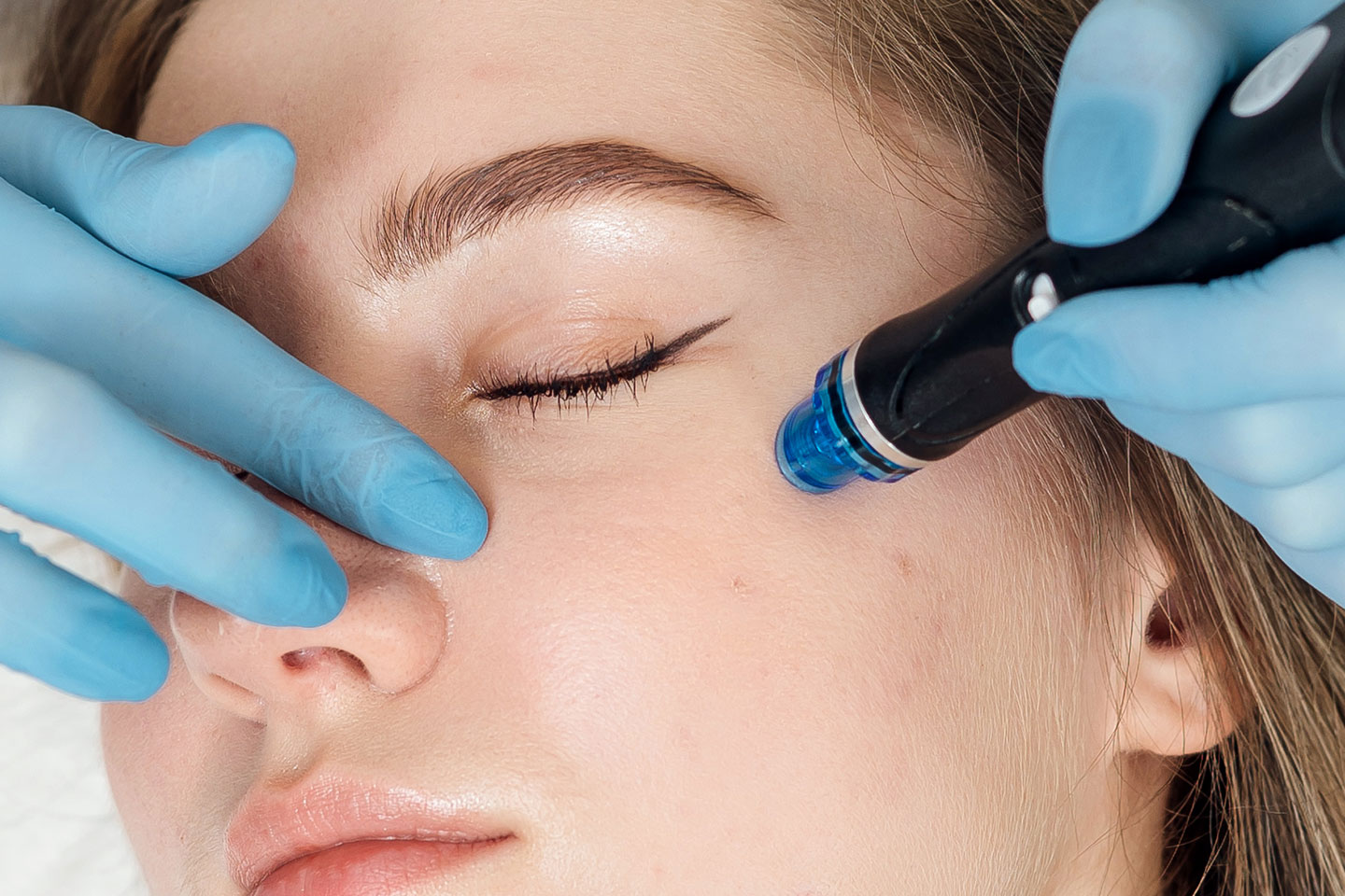 Microtoxin 1-3 behandlingstillfällen hos Filling Beauty i Limhamn