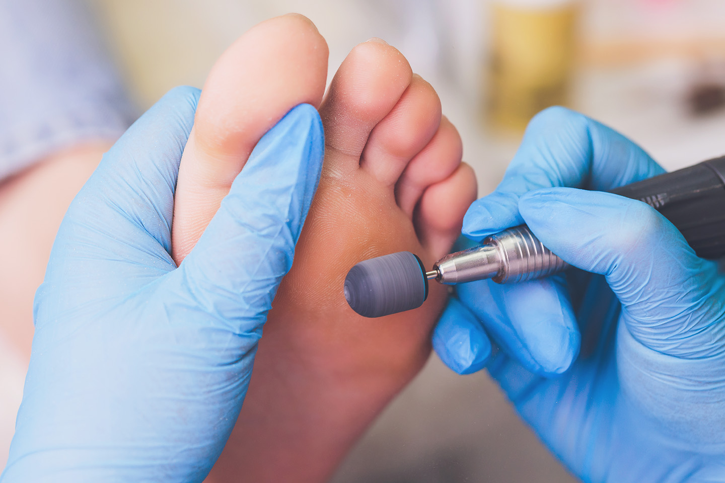 Medicinsk fotvård 45 min hos Improve Skin i Högsbo