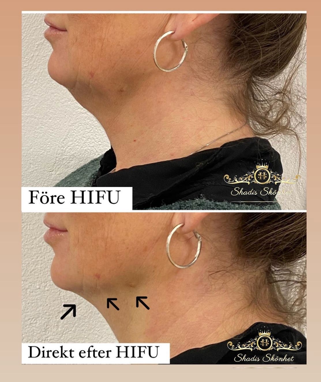 Ansiktslyft / hudåtstramning och fettreducering med HIFU 7D (1 av 14)