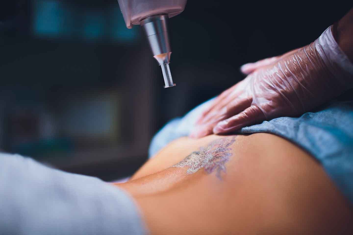 Ta bort oönskade tatueringar med Q-terra Q10 Laser hos Dottoressa Clinic (1 av 4)