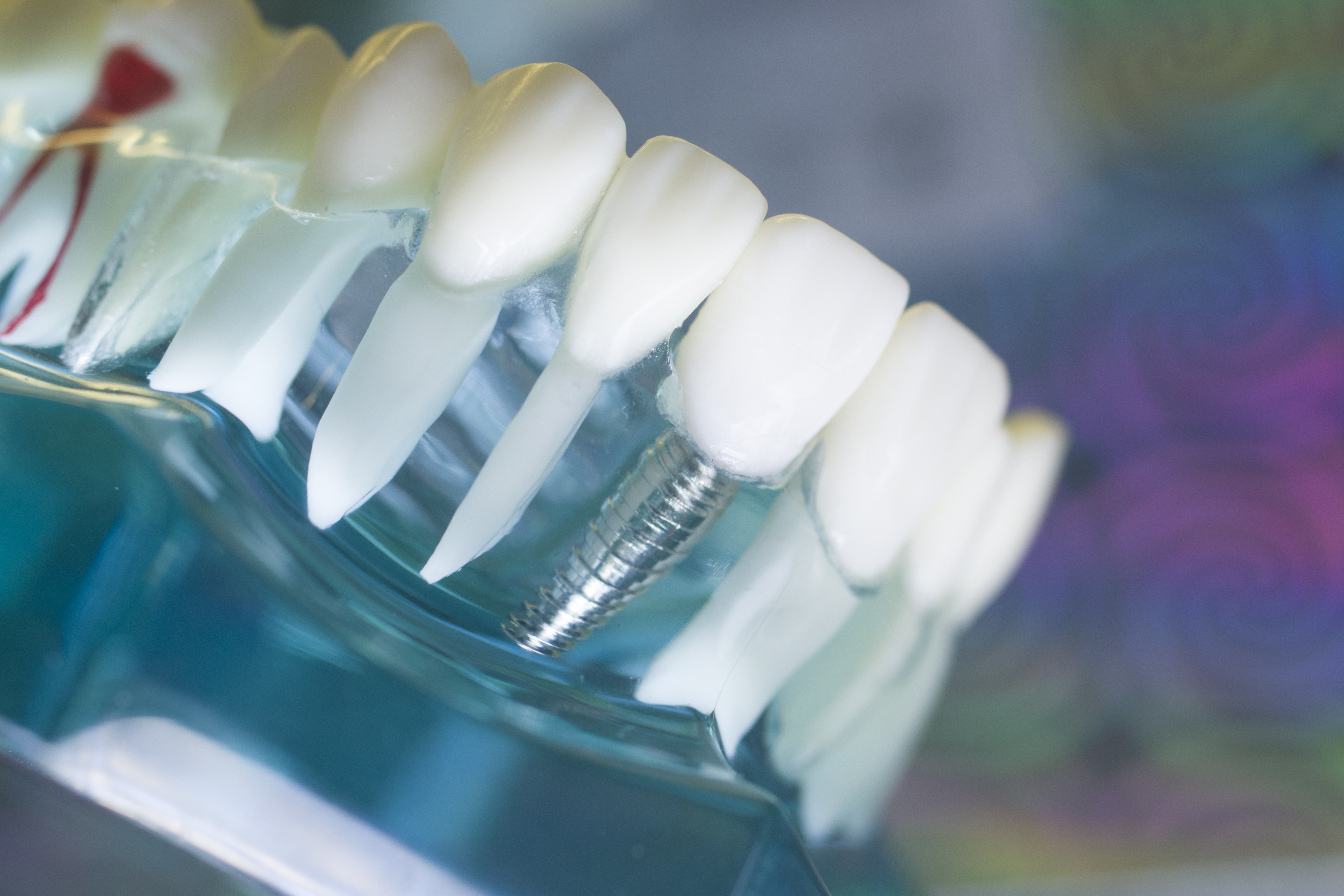 Implantatkonsultation + 5000 kr i presentkort hos DermaDent Sundbyberg