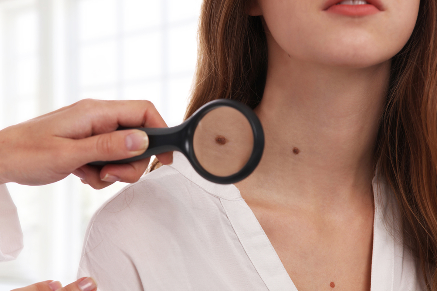 Fjerning av føflekk uansett størrelse med laser hos KLV Care